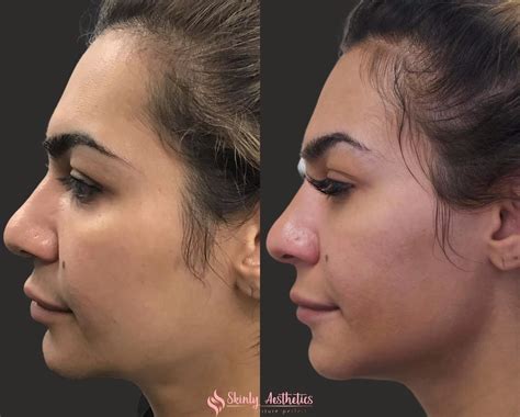 Jawline Fillers Before After Results At Skinly