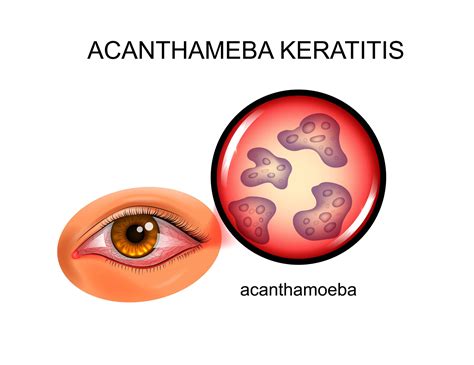 Keratitis Symptoms Causes And Treatments