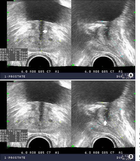 [pdf] Prostate Volume Measurement By Transrectal Ultrasonography