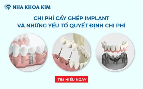 Trải nghiệm trồng răng implant nha khoa kim đẳng cấp và hiện đại