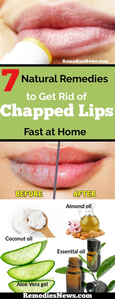 7 Natural Remedies to Get Rid of Chapped Lips Fast at Home