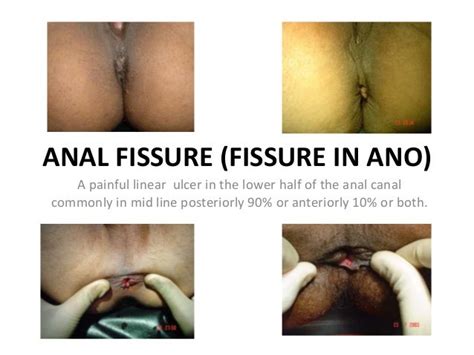 Anal Fissure Fissure In Ano Ppt