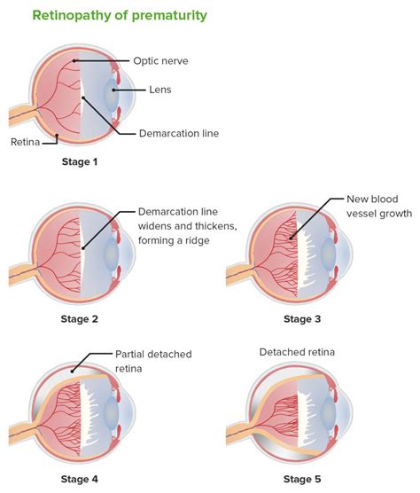 Retinopathy Of Prematurity Concise Medical Knowledge