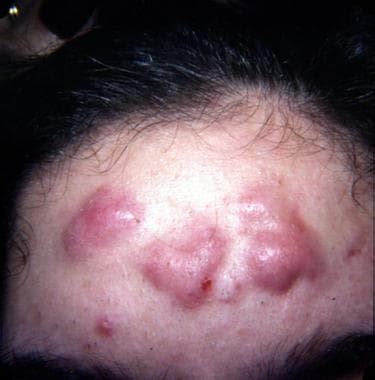 Acne Conglobata Scars