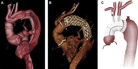 The Buffalo Trunk Technique For Aortic Arch Reconstruction The Annals