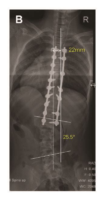 A 15 Year Old Female With Lenke 1bn Adolescent Idiopathic Scoliosis Download Scientific Diagram