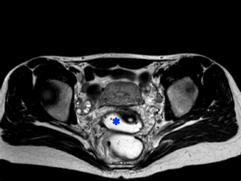 Figure 3 From Deep Endometriosis Of The Posterior Pelvic Compartment A Mri Pictorial Guide