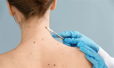 Skin Tag Removal For San Antonio Seguin And LaVernia TX Ross