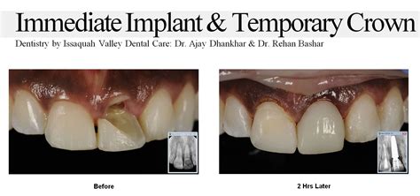 Immediate Implant & Temporary Crown | Temporary crown, Implants, Dental ...