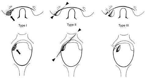 Left Occipital Condyle Fracture