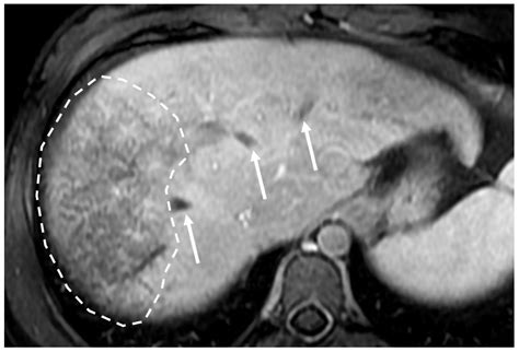 Budd Chiari Syndrome Imaging Diagnosis State Of The Art And Future