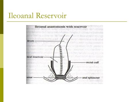 Ppt Bowel Diversion Ostomies Powerpoint Presentation Free Download