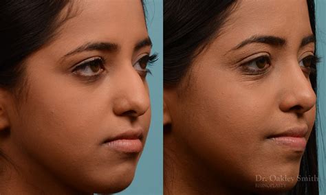 Rhinoplasty Before And After Case 285 Toronto Rhinoplasty Surgery