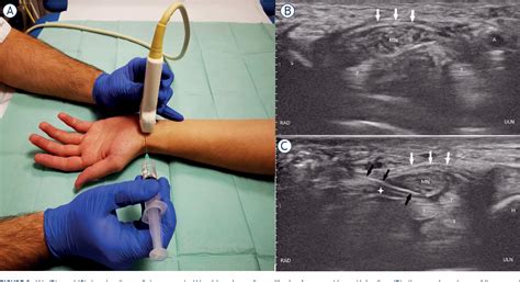 Figure 3 From Ultrasound Guided Carpal Tunnel Injections Semantic Scholar