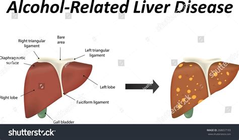 Alcohol Related Liver Disease With Steatosis Stock Vector Illustration 268657193 : Shutterstock