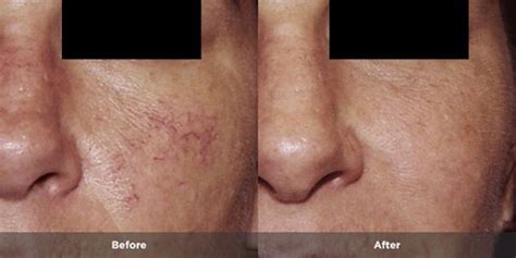 Rosacea Treatment Photos