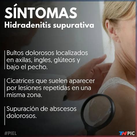 Hidradenitis Supurativa A Qué Síntomas Hay Que Estar Atento Tn