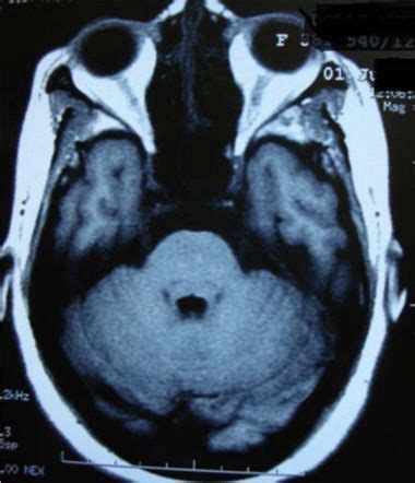 MRI Brain And Orbit Normal Ocular Scan