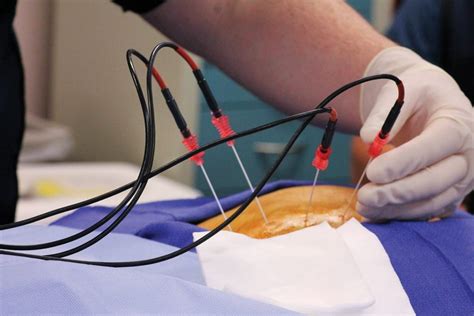 Radiofrequency Ablation Montana Advanced Pain Spine