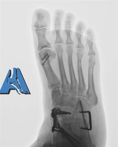 Severe Flat Foot Correction Via Triple Arthrodesis In Morbidly Obese