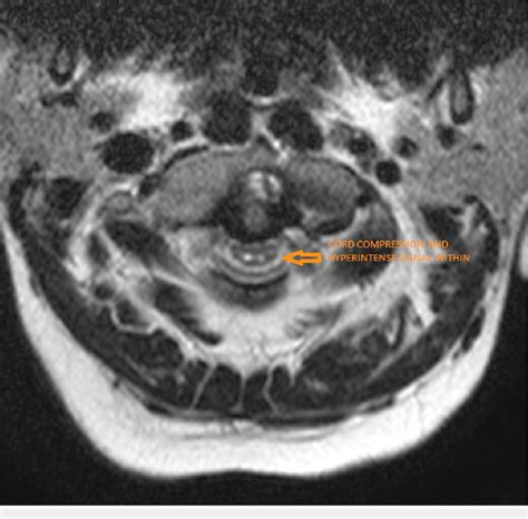 Axial T2 Weighted Magnetic Resonance Imaging Showing Compressive