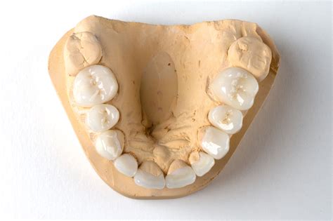 Zirconia Crown | Zirconia Dental Implant | Pindan Dental Lab