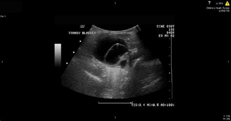 Urinary Bladder Ultrasound