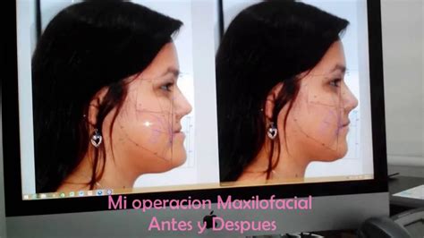 Mi Operacion Maxilofacial Antes Y Despues Estefanny Rodriguez Youtube