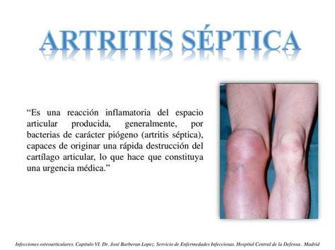 Artritis Septica Jos Luis P Rez Camacho Udocz