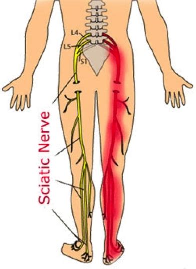 Lumbar radiculopathy - Dr. Wayne Kelley Jr., MD