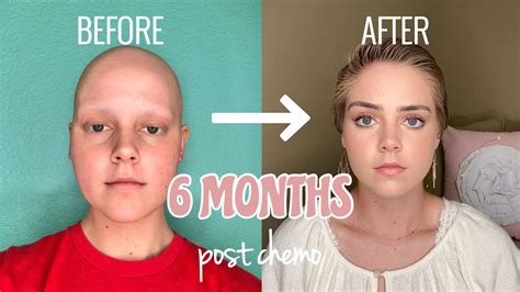 Chemotherapy Hair Loss Timeline