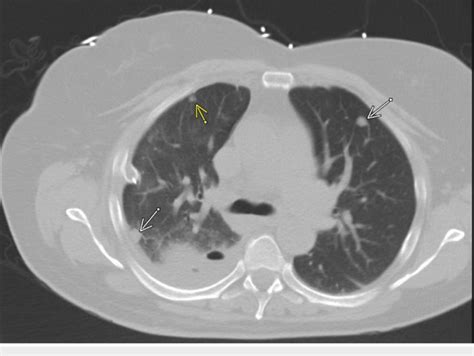 Chest Ct Scan 1 2015 Large Right Loculated Pleural Effusion With Download Scientific Diagram