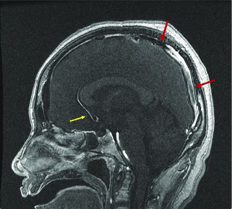 Initial Non Contrast Ct Head With No Acute Intracranial Abnormalities Download Scientific