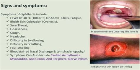 Diphtheria Causes Symptom And Complications Assignment Point