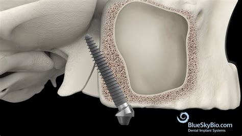 Pterygoid Implant Placement YouTube