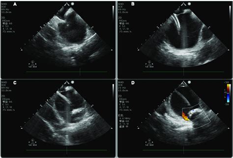 Intracardiac Echocardiography Guided Cryoablation A Ice Guided Low