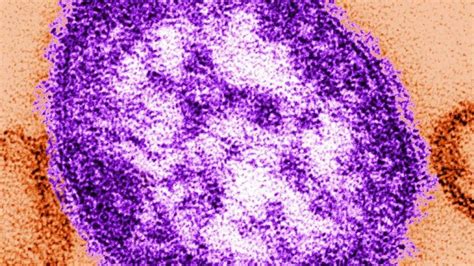 Ny Tackles Largest Measles Outbreak In State S Recent History I Vaccinate