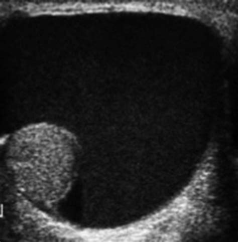 Us Of The Scrotum Acute Haematocele Hypoechoic Intrascrotal Collection