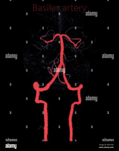 Ct Angiography Of The Brain Or Cta Brain Showing Basilar Artery Stock