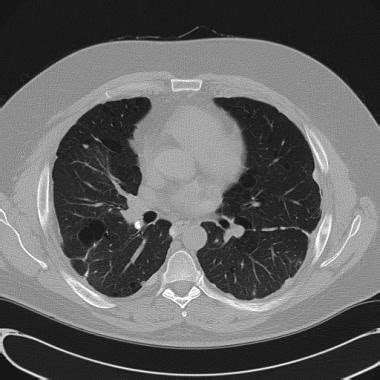 Pneumothorax Workup Approach Considerations Arterial Blood Gas