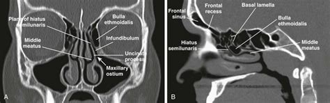 Sinus Anatomy Radiology