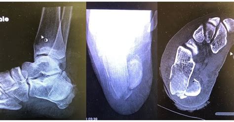 Revisiones Bibliogr Ficas Tyo Web Fractura Plantar Por Avulsi N Medial