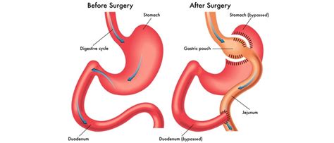 Cirugía De Bypass Gástrico Cómo Funciona Pros Y Contras