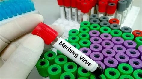 Waspadai Virus Marburg. Angka Kematian Tercatat Tinggi, Gejalanya Mirip DBD