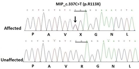 Dna Sequence Chromatograms Of The Proband Iii15 Shows A Heterozygous