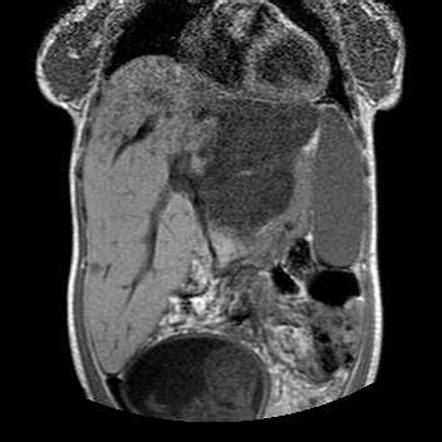 Hepatic Epithelioid Hemangioendothelioma Image Radiopaedia Org