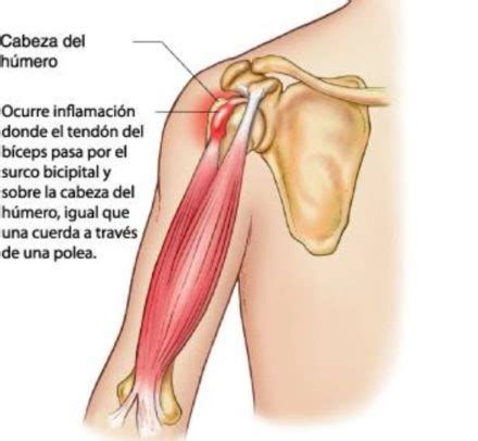 Tendinopatía bicipital causas y tratamiento