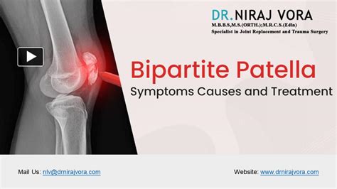 PPT Bipartite Patella Symptoms Causes And Treatment Dr Niraj Vora