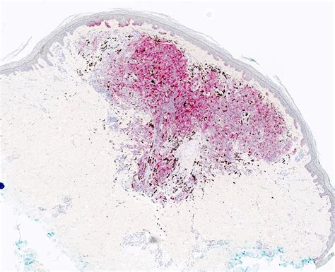 Pathology Outlines Wnt Activated Deep Penetrating Plexiform