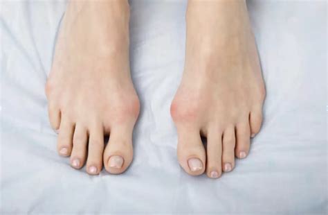 What Does A Bunion Look Like Common Symptoms